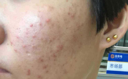 长春皮肤病医院：青春痘早期症状有哪些表现