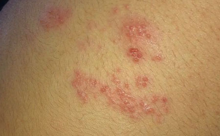 带状疱疹的症状是什么？