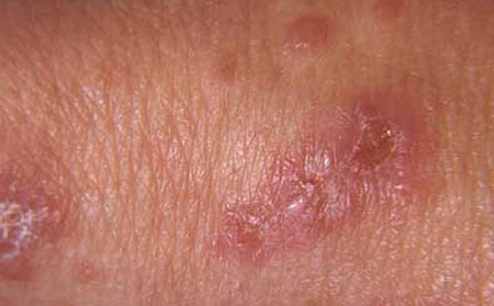 冬季皮肤瘙痒症的原因有哪些？