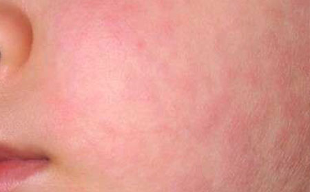 长春皮肤病研究所专家介绍：引起瘙痒的常见疾病有几种