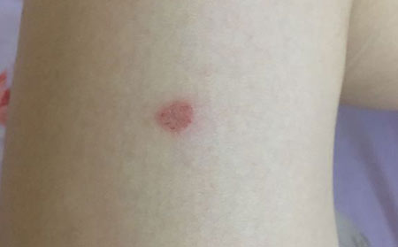 比较省钱的皮肤瘙痒调理方法
