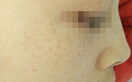 长春皮肤病研究所：雀斑症状特点有什么