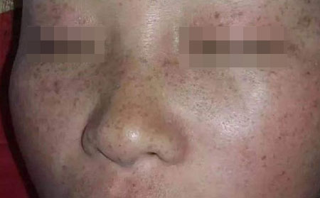长春治疗雀斑-雀斑详细的诊断标准