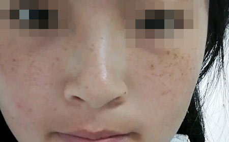 长春皮肤科皮肤病医院：日常生活中雀斑怎么预防