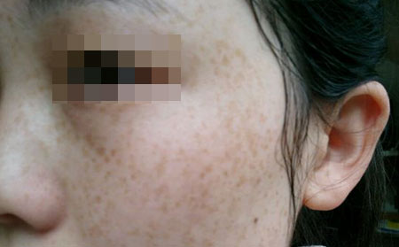 长春中吉皮肤病医院专家讲解：正确认识雀斑的危害