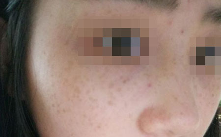 如何预防雀斑?长春治疗雀斑的医院