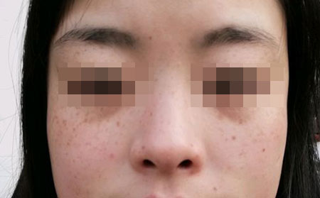 雀斑的主要症状有哪些