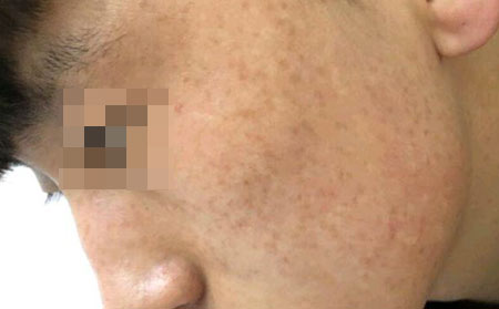长春雀斑治疗医院--雀斑是如何形成的