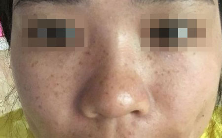 长春祛除雀斑的医院哪家比较好呢？长春皮肤病医院