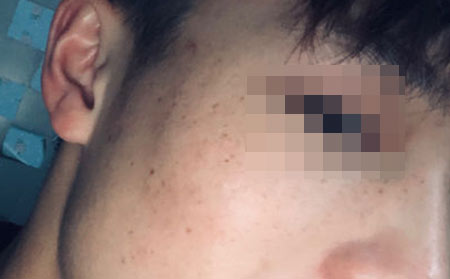 长春皮肤科皮肤病医院：雀斑形成的原因