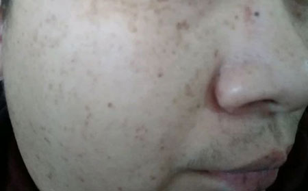 雀斑的形成原因是什么?患上雀斑饮食注意哪些