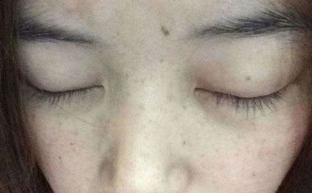 女性朋友该怎样的预防雀斑呢?
