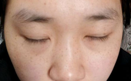 长春皮肤病研究所：如何有效的护理雀斑患者