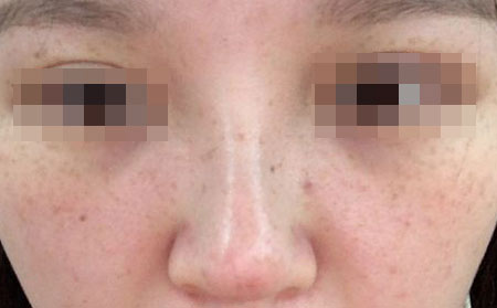雀斑患者应该多吃哪些水果?