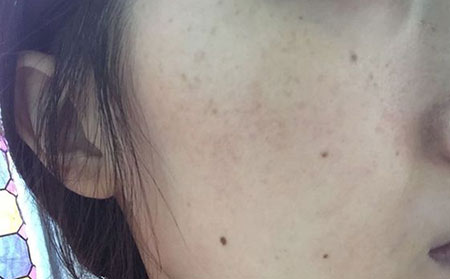 雀斑的危害都有哪些?