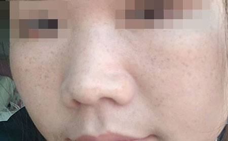雀斑的治疗方法有哪些