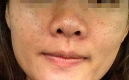 日常生活中应该怎么预防雀斑
