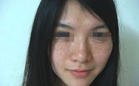 脸上长有雀斑是哪些原因导致的呢?