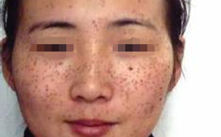 长春治疗雀斑的原则是什么