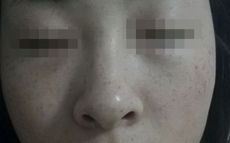 长春祛斑医院--雀斑是如何形成的