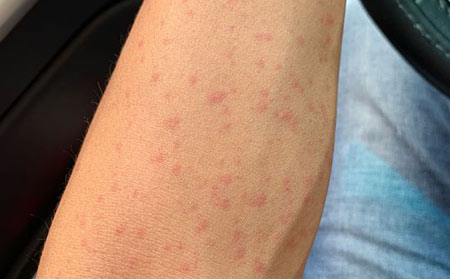 急性荨麻疹有什么症状呢?