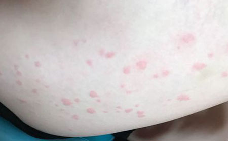 长春皮肤病研究所：常见的荨麻疹症状是什么