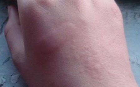 长春中吉讲解急性荨麻疹的症状？