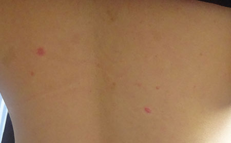 得了荨麻疹有哪些症状?