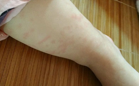 长春皮肤病研究所专家解说:冬季常见的荨麻疹有哪些类型