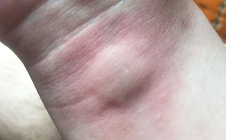 婴儿为什么会患上荨麻疹疾病