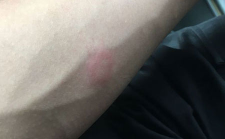 荨麻疹治疗方法具体是哪些?
