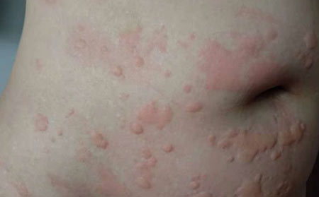 过敏性荨麻疹形成的危害？