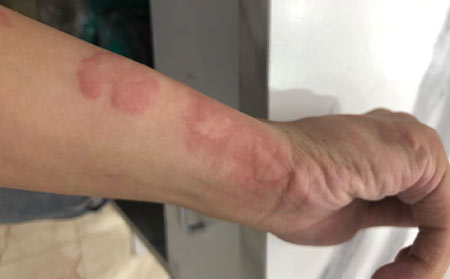 荨麻疹怎么引起的呢