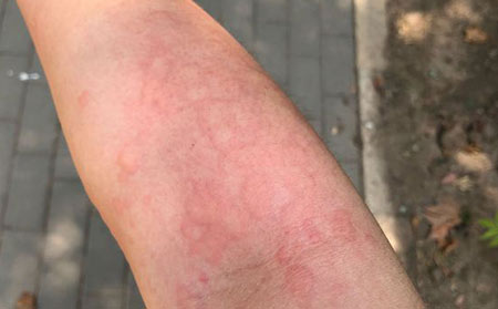 不同荨麻疹的病症