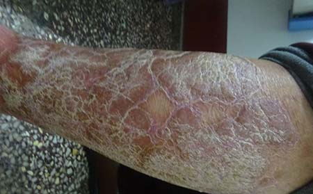 孕妇患有牛皮癣应该要注意什么