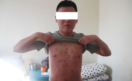 哪些原因会导致牛皮癣病情复发