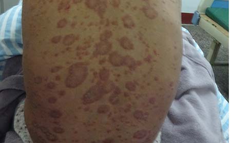 进行期牛皮癣痒怎么办？