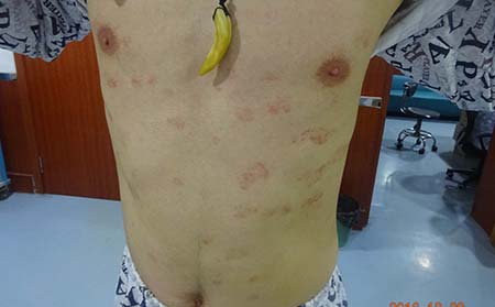 长春中吉专家讲解：治疗牛皮癣需注意什么