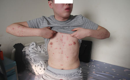 牛皮癣患者应该要怎么预防病情复发