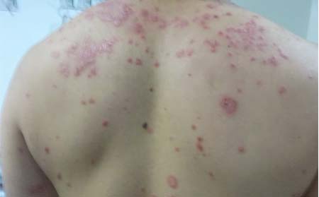长春看牛皮癣哪里好