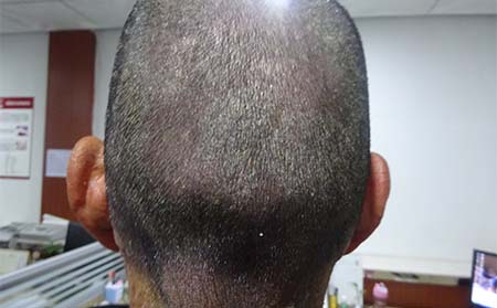 长春治疗牛皮癣:咽炎也能诱发顽固牛皮癣