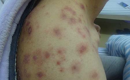 长春中吉医院讲解：什么医院治牛皮癣好