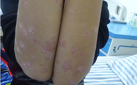预防牛皮癣复发有哪些好方法