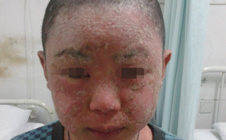 寻常型牛皮癣的预防如何进行